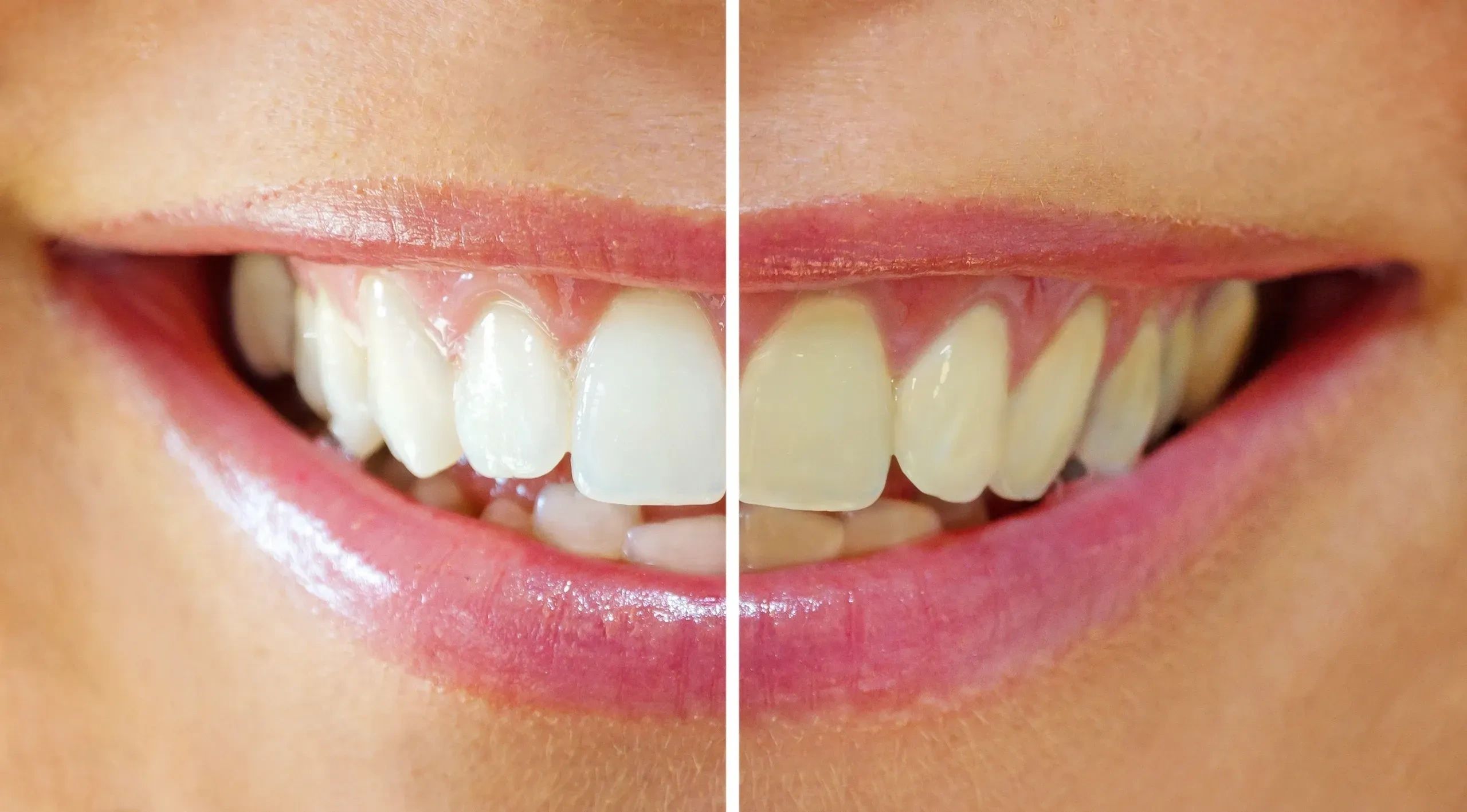 Professional Teeth Whitening Treatment.